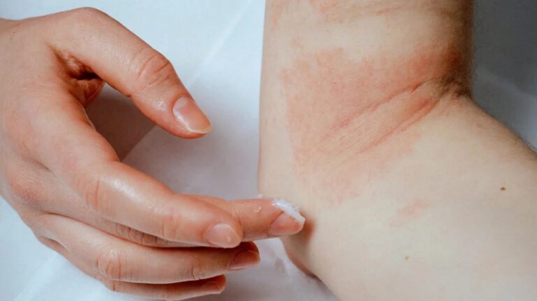 Why Applying the Right Eczema Cream Is Vital when Dealing with Eczema